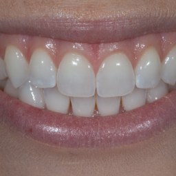 How to close the gap between my teeth?